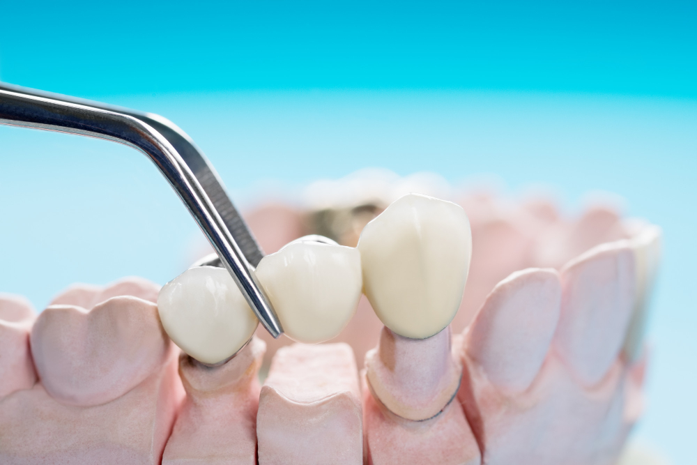 how long do dental bridges last
