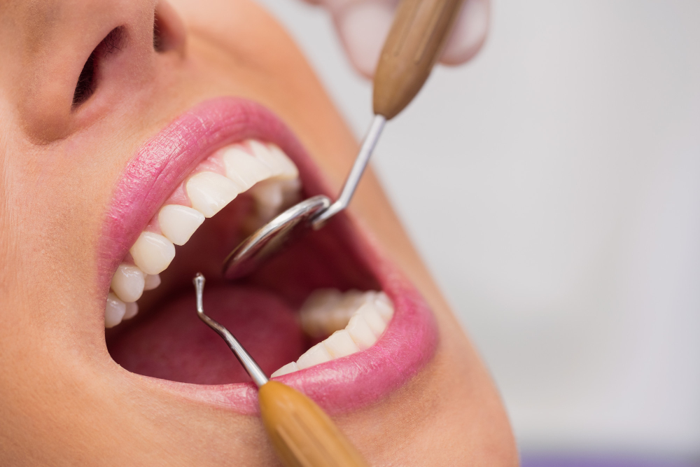 Professional dental cleaning in Mississauga, ON