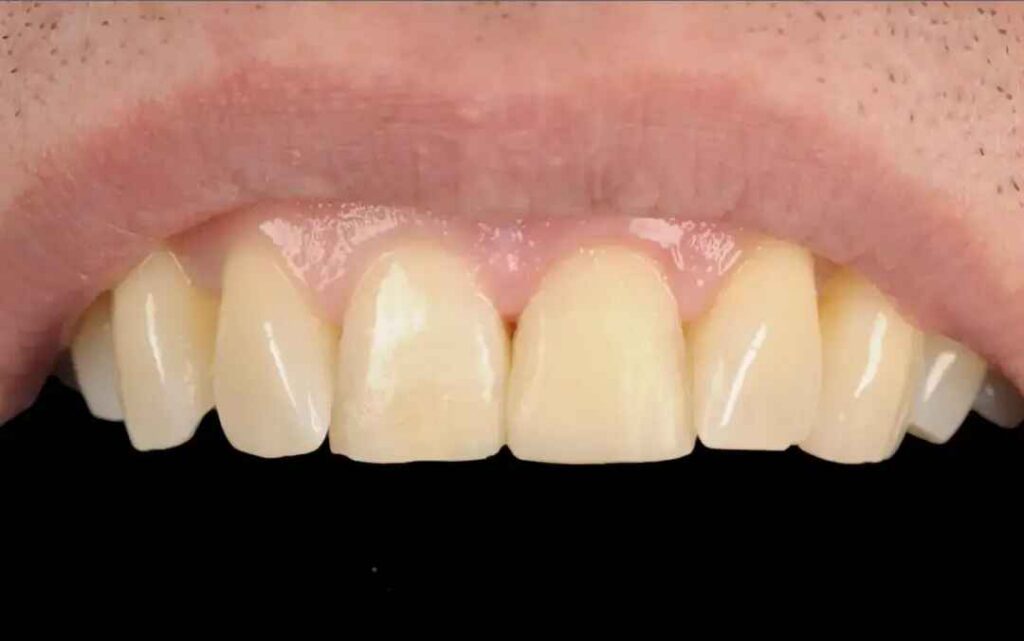Before and after composite bonding to restore uneven upper front tooth edges.”