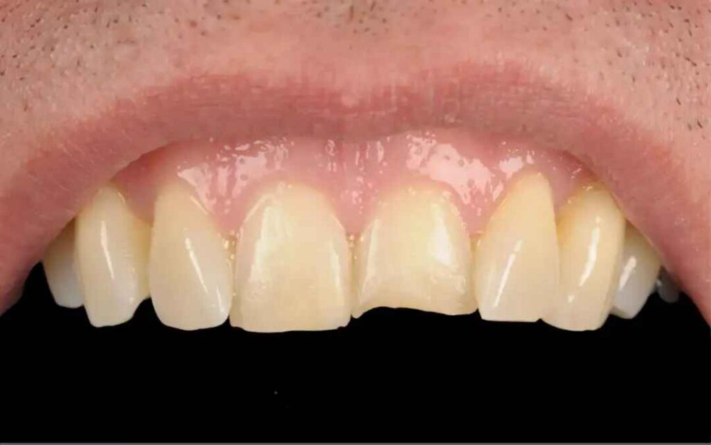 Before and after composite bonding to restore uneven upper front tooth edges.”