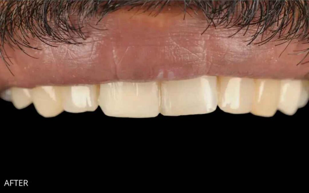 Before and after composite bonding to repair a chipped upper front tooth