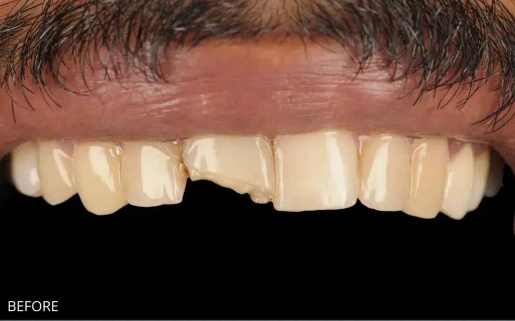 Before and after composite bonding to repair a chipped upper front tooth